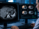 Inteligencia artificial para detectar daño hepático